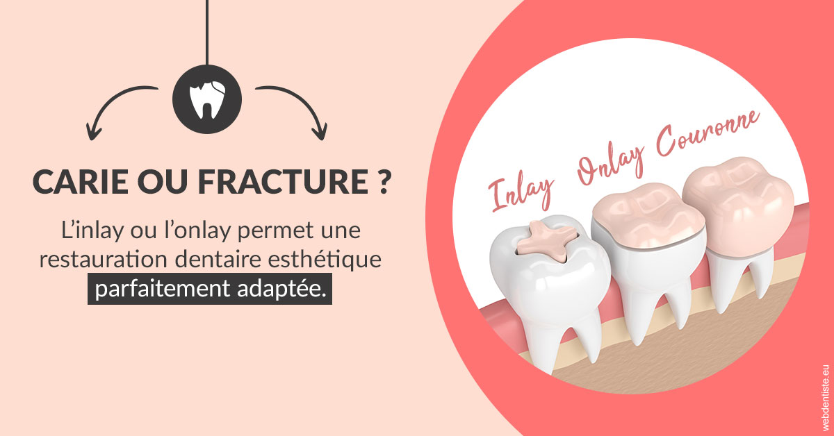 https://dr-simon-helene.chirurgiens-dentistes.fr/T2 2023 - Carie ou fracture 2