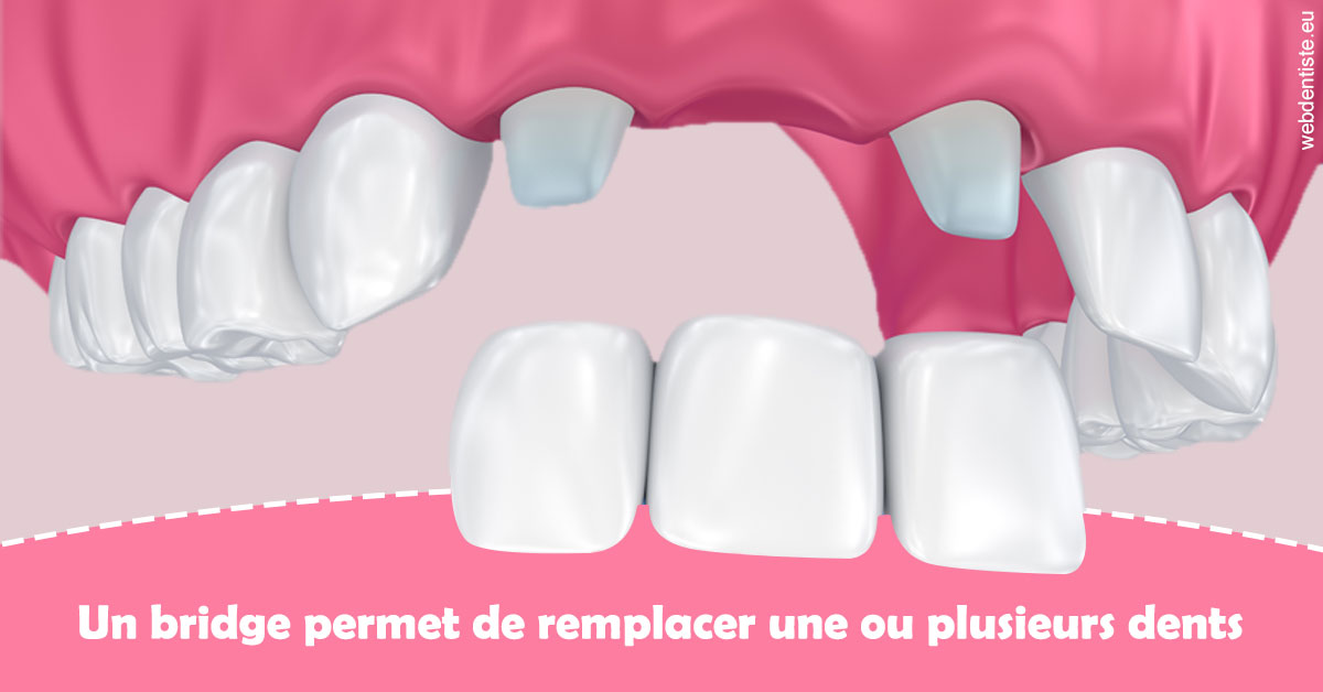 https://dr-simon-helene.chirurgiens-dentistes.fr/Bridge remplacer dents 2