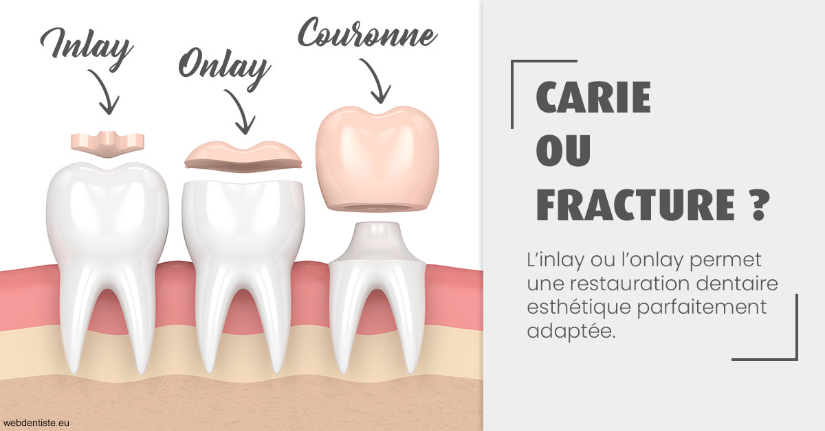 https://dr-simon-helene.chirurgiens-dentistes.fr/T2 2023 - Carie ou fracture 1