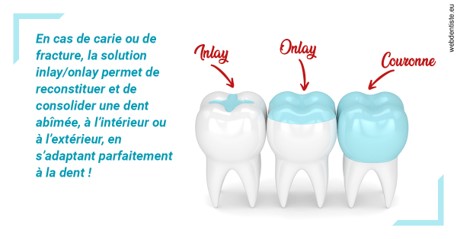 https://dr-simon-helene.chirurgiens-dentistes.fr/L'INLAY ou l'ONLAY