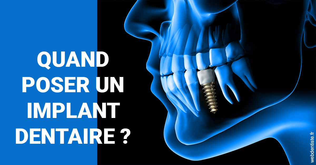 https://dr-simon-helene.chirurgiens-dentistes.fr/Les implants 1