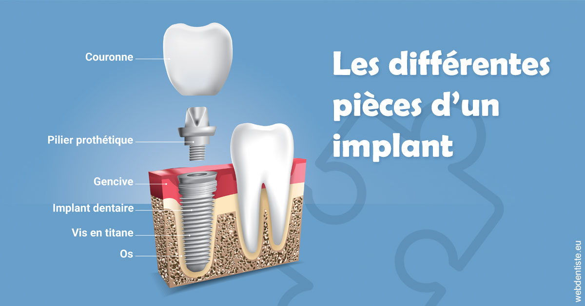 https://dr-simon-helene.chirurgiens-dentistes.fr/Les différentes pièces d’un implant 1